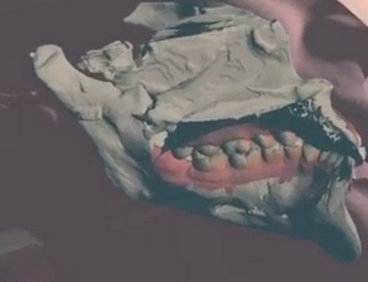 The jaw bone and teeth from a CBCT scan, shown inside the aligned 3D model on Apple Vision Pro.