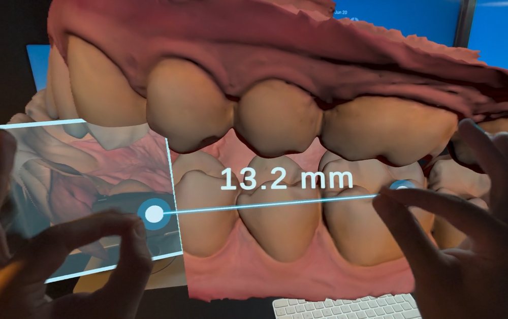 Two hands holding the ends of a ruler across an aligned 3D dental scan on Apple Vision Pro; the ruler shows the distance in millimetres.